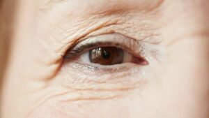 laza szemhéjbőr kezelése Budapesten